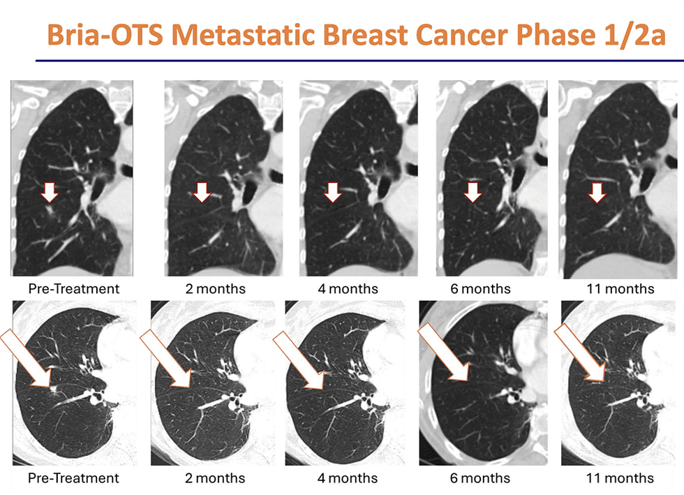 Briacell series of lung CT scans over time with arrows indicating changes, labeled Pre-Treatment to 11 months; Text reads: Bria-OTS Metastatic Breast Cancer Phase 1/2a.