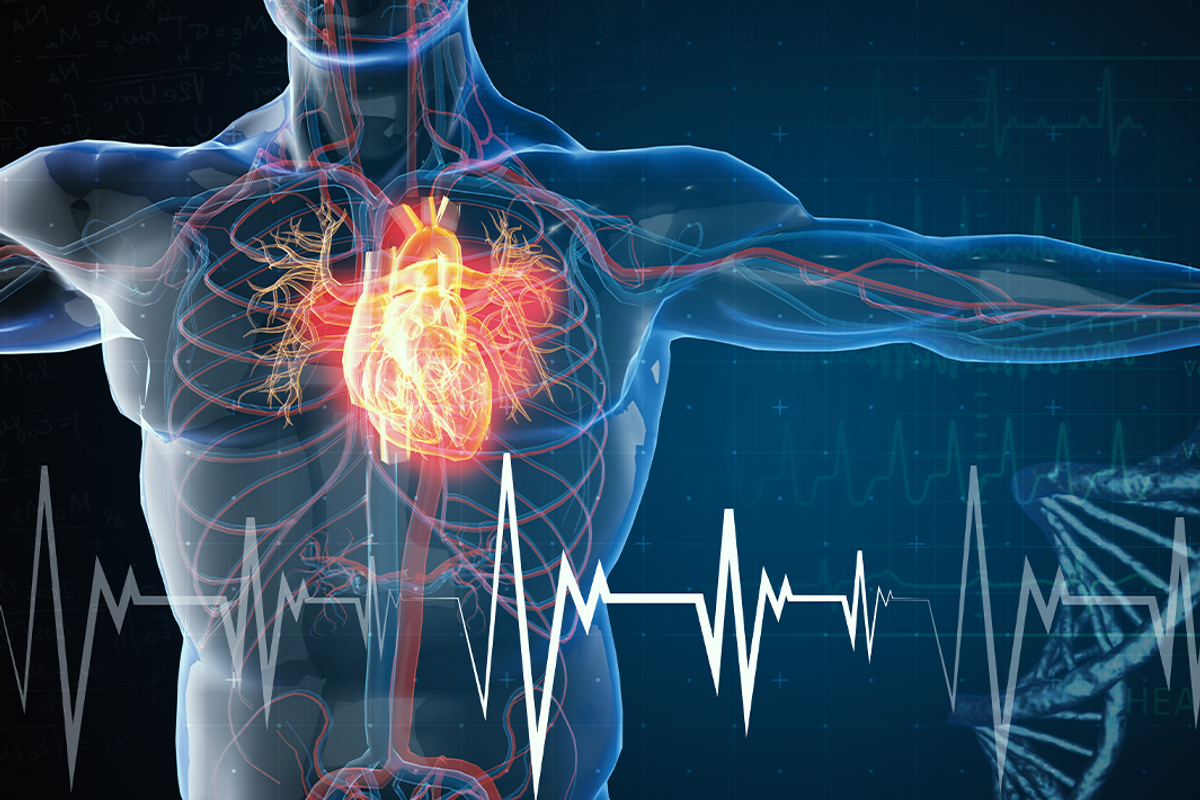 Illustration of heart attack.