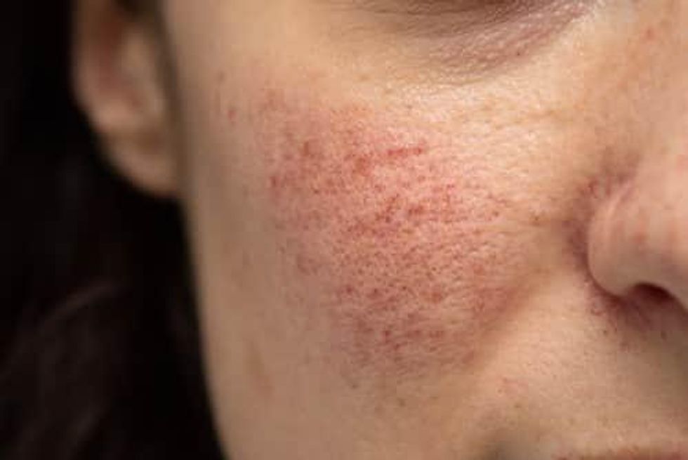 The Unspoken Potential of Rosacea Treatments