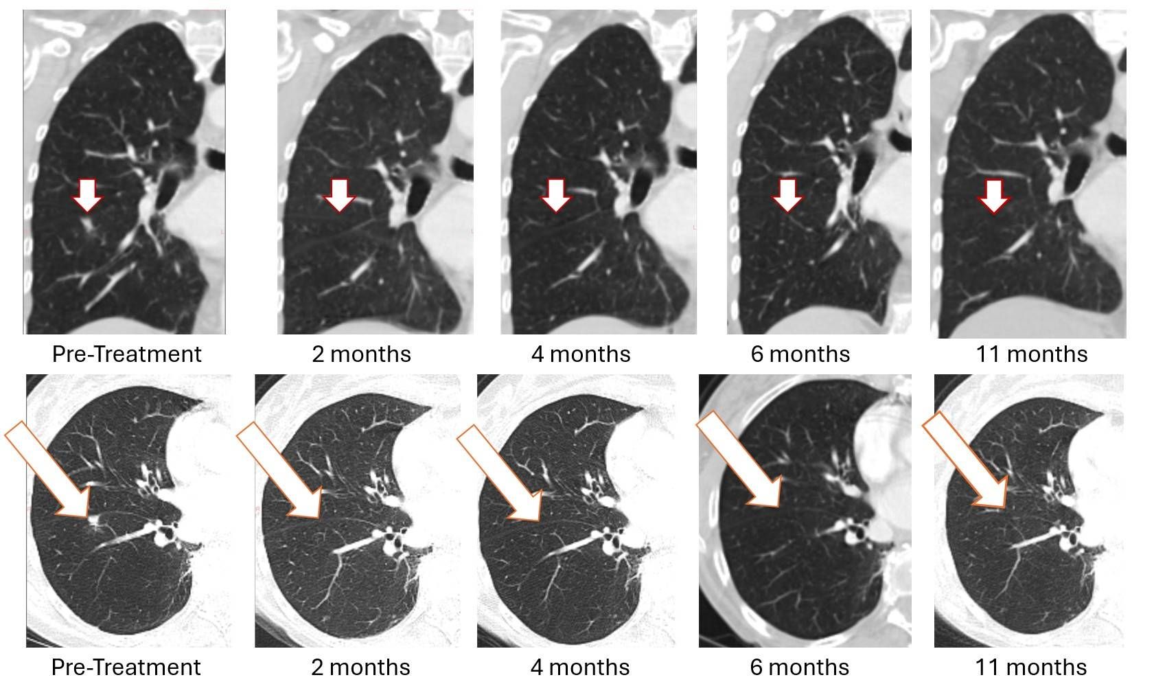 BriaCell Reports Sustained Complete Resolution of Lung Metastasis in Bria-OTS™ Patient