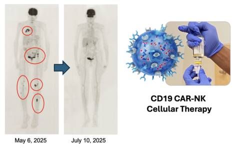 Accompanying figure is a PET scan of the complete response in the patient with multiple bone tumors and this CR is ongoing for seven months to date.