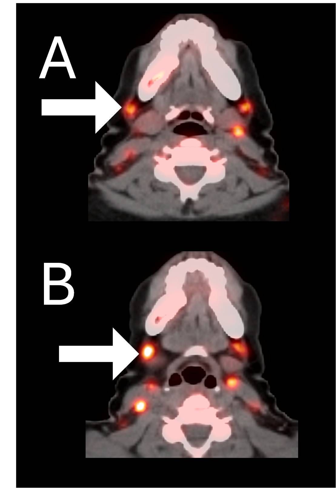 Example 2 Images (Patient 15-005): CD8 ImmunoPET images pre (A) and post (B) Bria-IMT treatment