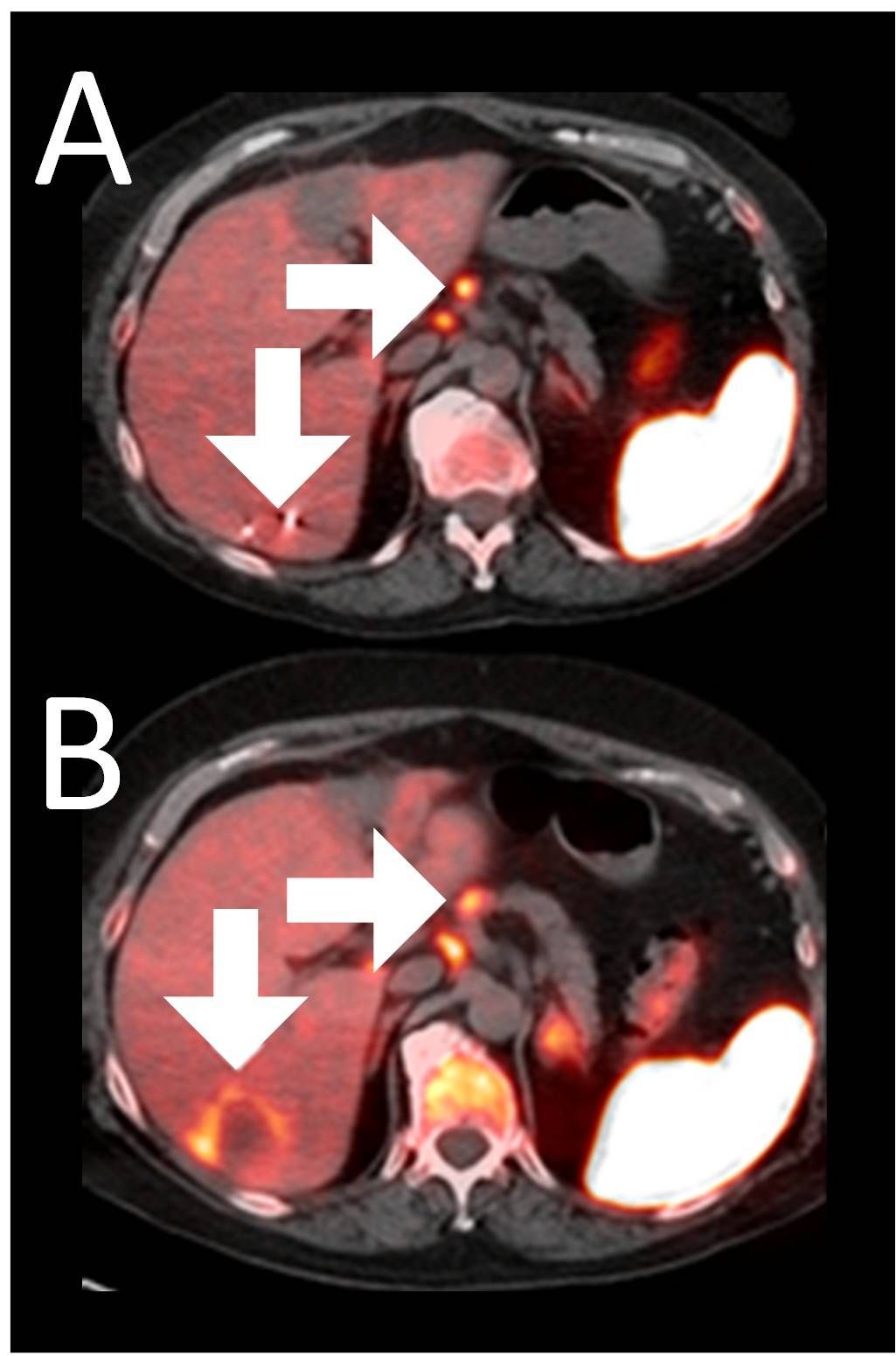 Example 3 Images (Patient 15-006): Combined MRI and CD8 ImmunoPET images Pre (A) and Post (B) Bria-IMT treatment