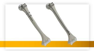 Stryker's T2 Alpha Humerus Nailing System