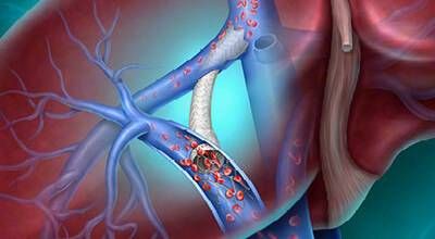 BD Delivers Next‑Generation TIPS Innovation to Advance Portal Hypertension Care Across the European Union