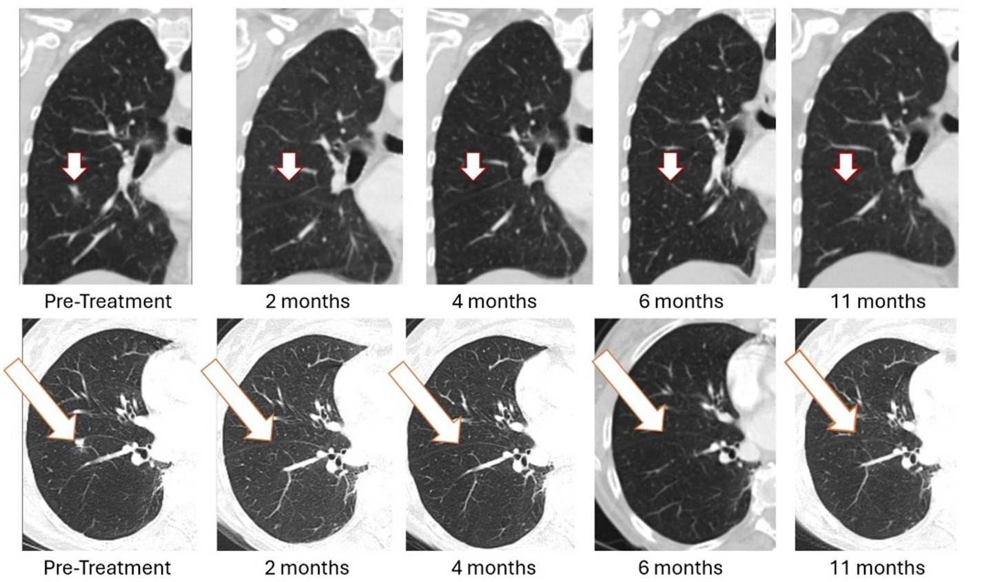 As previously reported in January 2026, treatment with Bria-OTS monotherapy resulted in 100% resolution of tumor in the right lung of the metastatic breast cancer (MBC) patient following 2 months of therapy and confirmed at 4, 6, and 11 months of therapy1 (axial and coronal views)