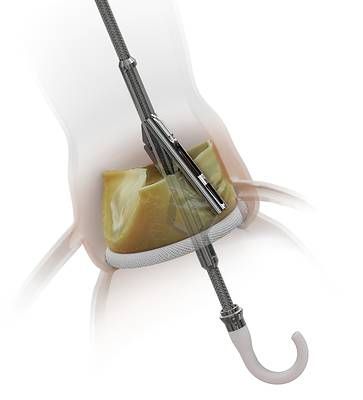 Pi-Cardia ShortCut™ Device