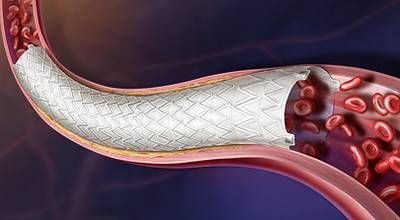 New AGILITY trial data presented at VIVA 2026 reinforce BD's commitment to advancing peripheral vascular care. Nine-month results from the iliac cohort showed strong safety and effectiveness outcomes for the Revello™ Vascular Covered Stent, including 97.2% primary patency and 98.3% freedom from clinically driven target lesion revascularization. Together, these findings expand the growing body of evidence supporting innovative treatment options for patients with PAD.