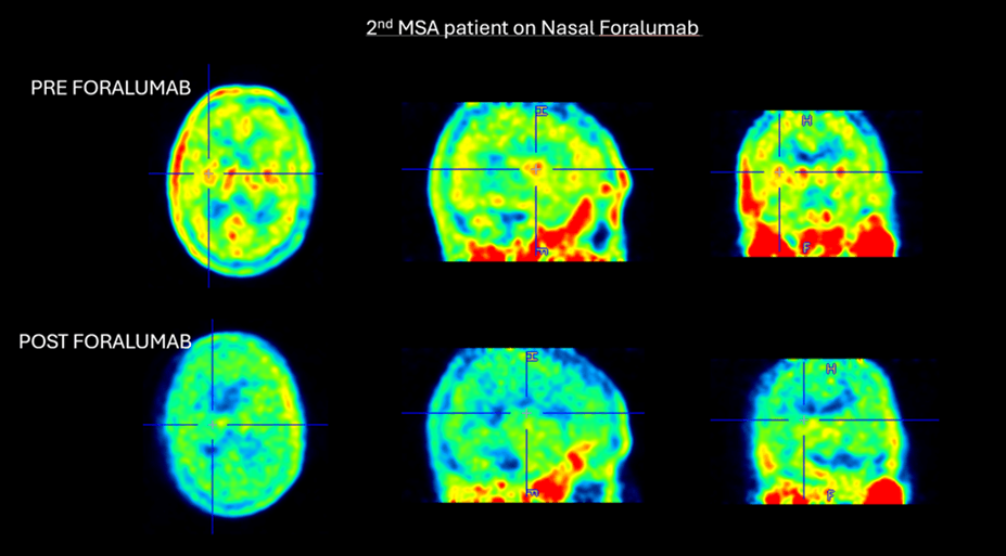 Significant reduction in basal ganglia and thalamic uptake following nasal foralumab