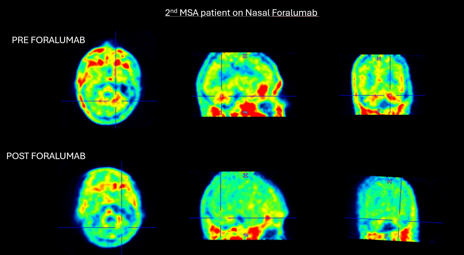 Marked reduction in Cerebellar white matter uptake following nasal foralumab