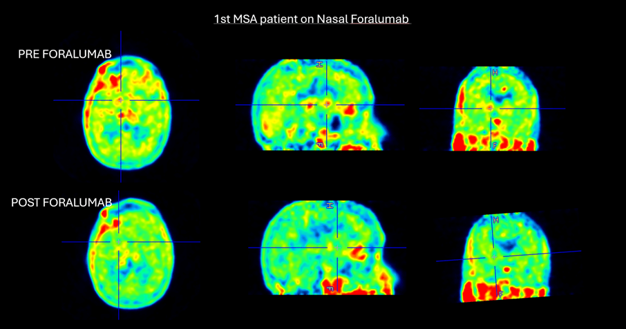 Marked reduction in basal ganglia uptake following nasal foralumab