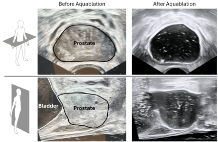 Ultrasound-guided, transurethral robotic waterjet resection of the prostate designed to remove cancer, at-risk tissue, and any obstructive tissue resulting in >95% of the gland being resected leaving only the outer prostatic capsule intact.