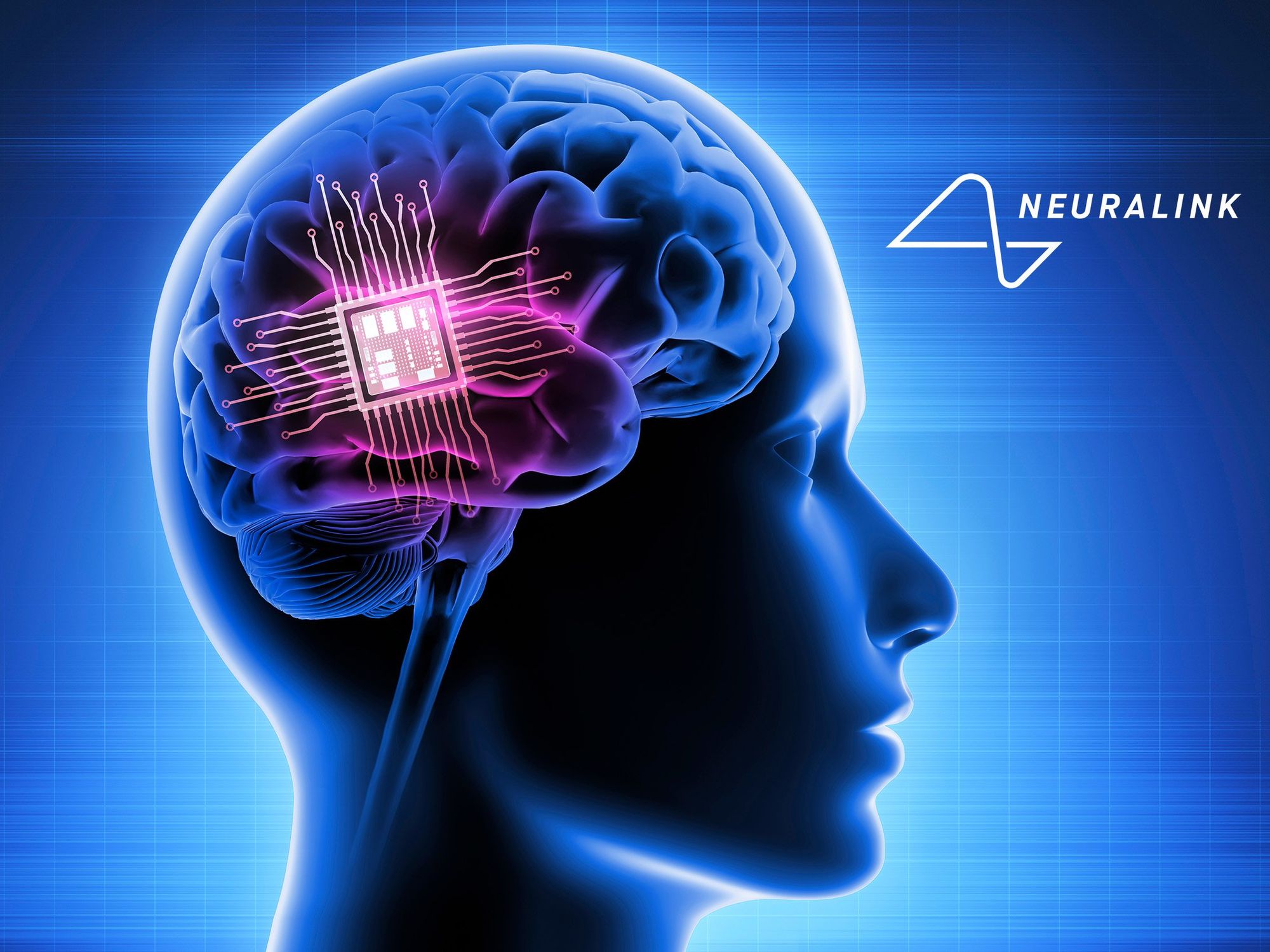 Can You Invest in Neuralink? | INN